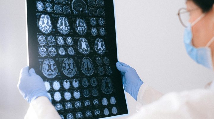 Identifican en sangre biomarcadores relevantes para el diagnóstico y el seguimiento de pacientes con epilepsia